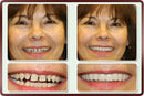 Facetas Odontológicas - SmileVeneers - Divino Produto
