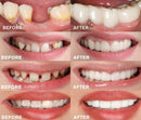 Facetas Odontológicas - SmileVeneers - Divino Produto