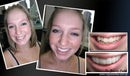 Facetas Odontológicas - SmileVeneers - Divino Produto