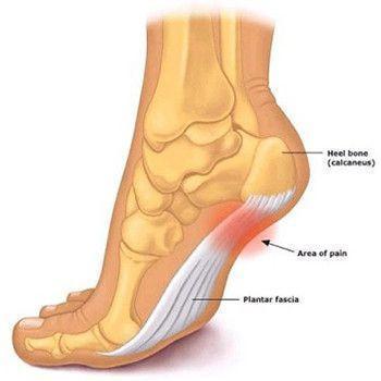 Faixas Terapêuticas 1 Par - Alivia a Fascite Plantar, Dores nos Calcanhares e Edemas!