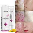 Rtopr Creme de Remoção de Cicatriz e Acne